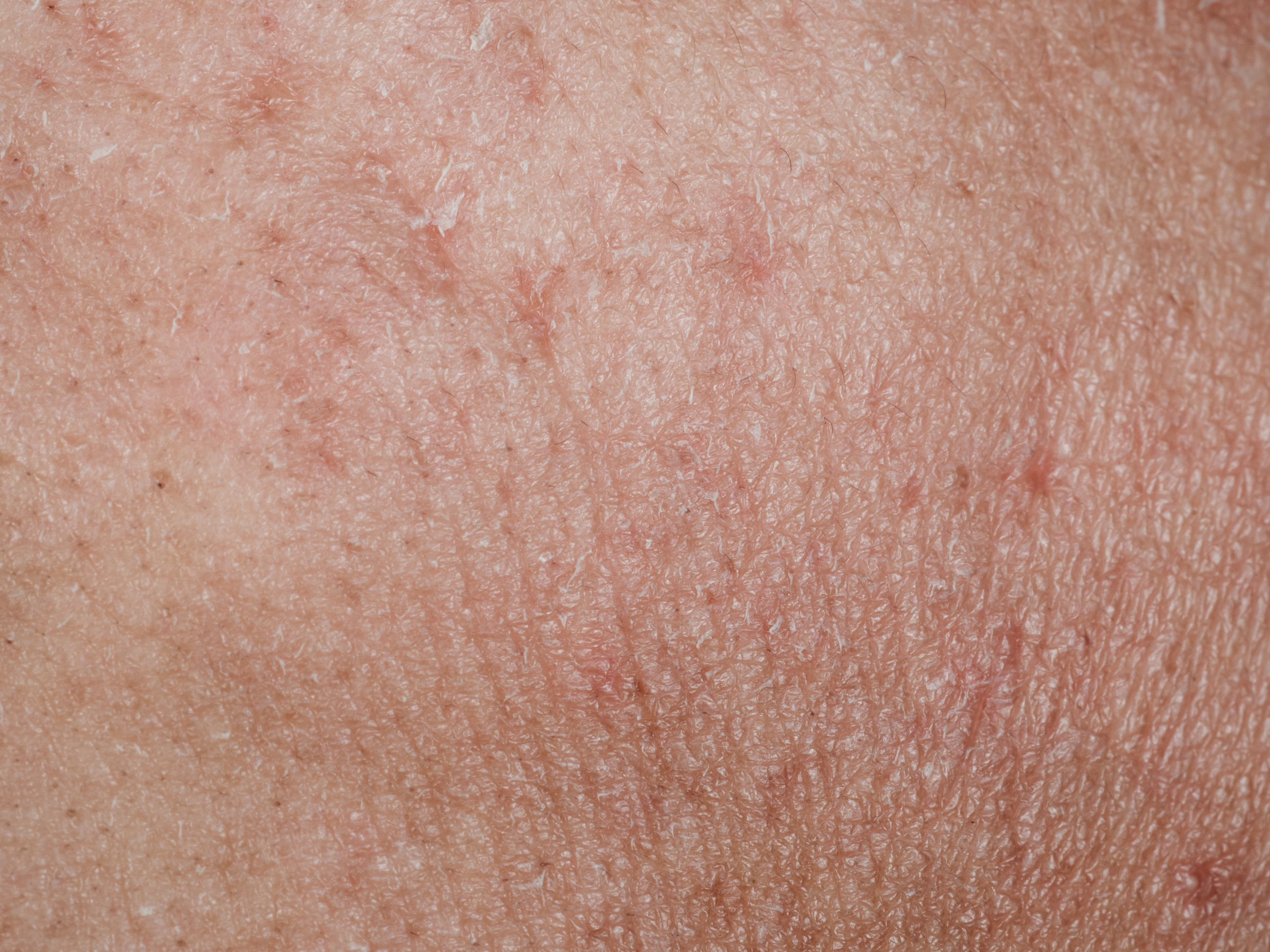 ill dry skin texture